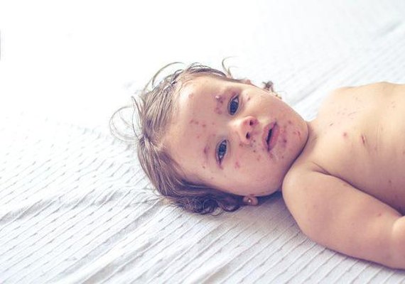 Sarampo: por que Brasil não tem casos enquanto mortes aumentam no mundo?