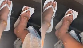 Mulher viraliza com impressionante reação a picadas de insetos durante lua de mel