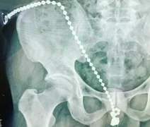 Homem passa por procedimento cirúrgico após introduzir bolinhas do prazer no pênis