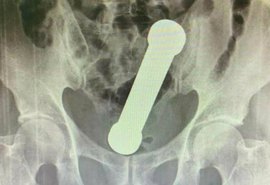 Médicos retiram peso de academia de dentro de paciente