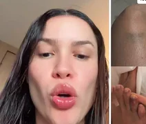 Juliette mostra hematomas após despedida de solteira: “Fim do mundo”