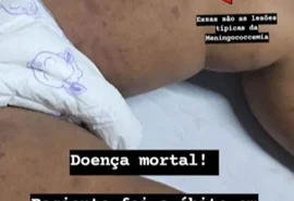 Bebê de um ano morre por meningite em Maceió