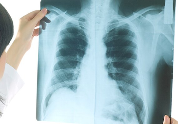 Universidades desenvolvem apoio a diagnóstico de covid-19 com raio-x