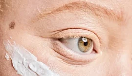 Pessoas com albinismo têm acesso gratuito a protetor solar em Maceió