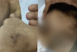 Criança de apenas 5 anos é intubada após ser espancada