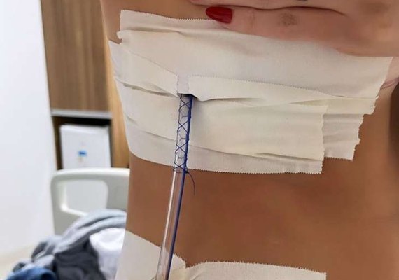 Empresária tem pulmão perfurado após realizar sessão de acupuntura