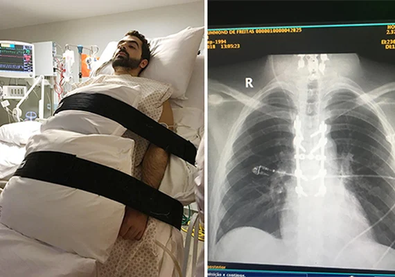 Cientista da UFRJ cria proteína que pode recuperar movimentos após lesão na medula