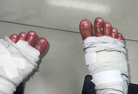 Influenciadores sofrem queimaduras durante prova de reality