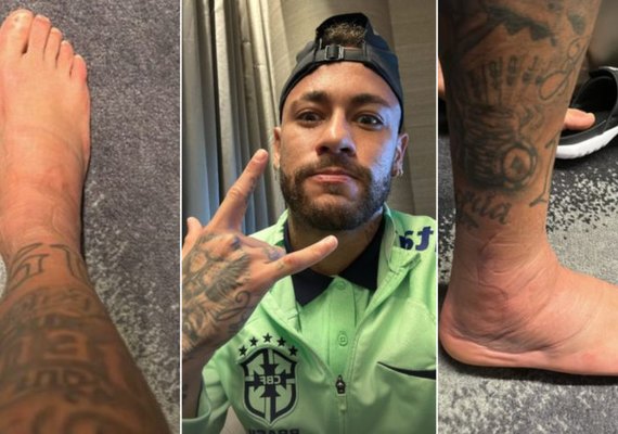 Polêmico, Neymar mostra fotos de seu tornozelo inchado; veja