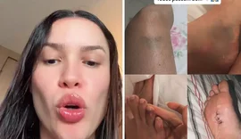 Juliette mostra hematomas após despedida de solteira: “Fim do mundo”