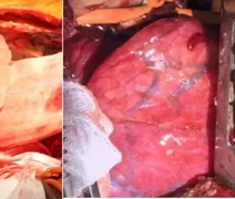 Pulmão de porco modificado é transplantado em homem pela 1ª vez