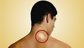 Em Alagoas, 334 novos casos de hanseníase ocorreram em 2018