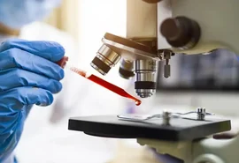 Proteínas encontradas no sangue podem indicar câncer com 7 anos de antecedência