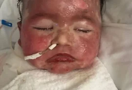 Bebê que sofreu reação alérgica tem piora no estado de saúde