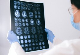 Impacto cognitivo da Covid-19 pode envelhecer cérebro em 10 anos