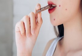 Chocolate causa espinha? Especialistas explicam relação entre dieta e acne