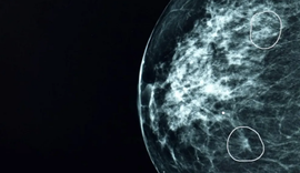 Cancêr de mama: A ferramenta de IA capaz de detectar tumores que passaram desapercebidos por médicos