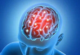 Marcapasso cerebral ajuda no tratamento do Parkinson e do TOC grave