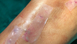 Pesquisadores de Pernambuco atestam eficácia de curativo pós-cirúrgico feito à base de cana-de-açúcar